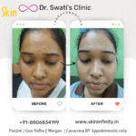 Dr Swati's aesthetic before after 2
