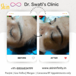 Dr Swati's aesthetic before after 1